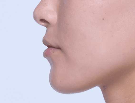 Jawline profile after Restylane LYFT treatment
