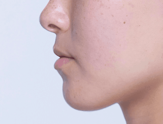 Jawline profile before Restylane LYFT treatment