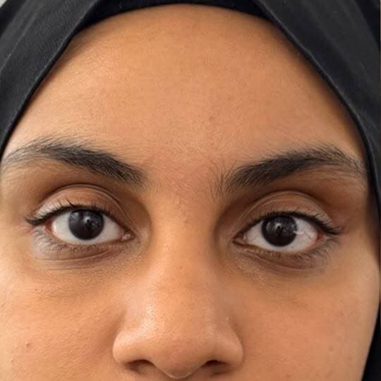 Under-eye area before Teosyal Redensity 2 treatment
