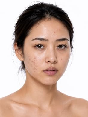 Acne and scar treatment