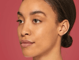 Cheeks before Restylane VOLYME treatment